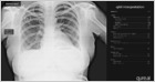 Experts say AI-based apps like qXR, which help clinicians diagnose tuberculosis early, could make an enormous impact on the control of the disease in India (Apoorva Mandavilli/New York Times)